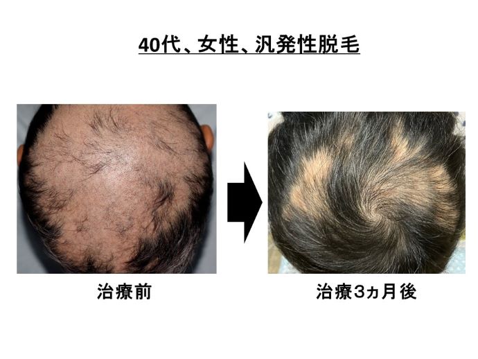 円形脱毛症　病院